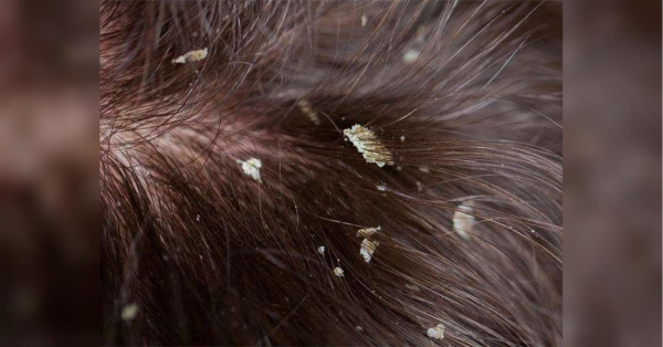 Коштують копійки: як за допомогою аспірину та кокосової олії позбутись лупи - INFBusiness