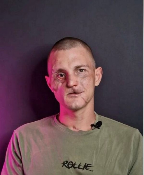 Після тяжкого поранення обличчя, втрати кісток черепа та зору воїн повернувся на службу: пластичний хірург про роботу в умовах війни - INFBusiness