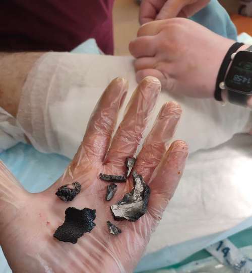 «Нам потрібен оригінальний Китай, а не німецька підробка»: завдяки магнітним інструментам волонтерів хірурги дістають уламки й кулі з найглибших ран - INFBusiness