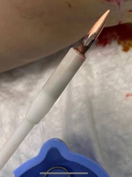 «Нам потрібен оригінальний Китай, а не німецька підробка»: завдяки магнітним інструментам волонтерів хірурги дістають уламки й кулі з найглибших ран - INFBusiness