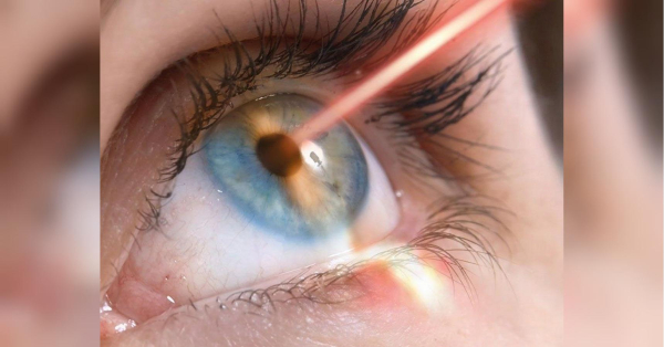 Лазерна корекція зору: комплексний посібник для бачення без окулярів - INFBusiness