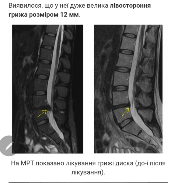 «Велику міжхребцеву грижу, яка викликає нестерпний біль, можна вилікувати без операції на хребті в 98% випадків», — професор Гонгальський - INFBusiness